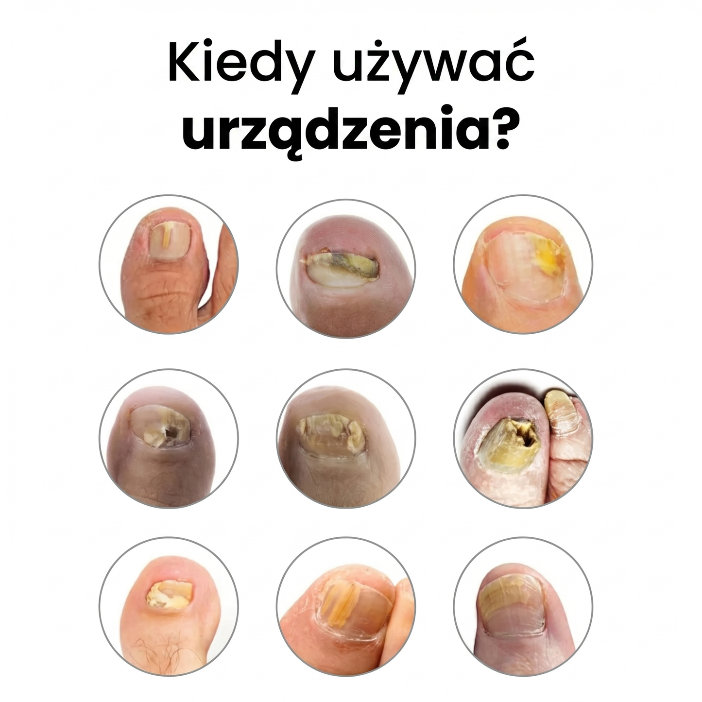 Urządzenie przeciw grzybicy MVP11
